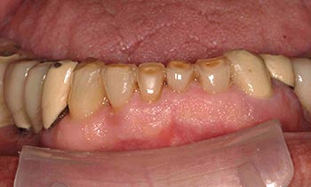 Short darkly colored bottom teeth