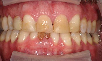 Damaged bottom tooth and discolored smile