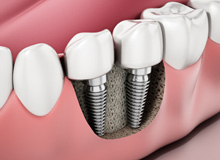 Illustration of dental implants in jawbone