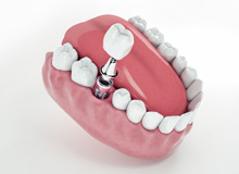 Illustration of abutment and dental crown being attached to dental implant