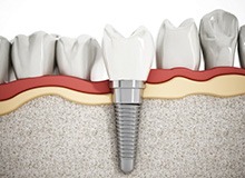 a 3 D example of a dental implant and abutment