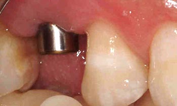 Dental implant visible in gums