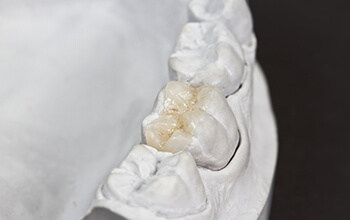 Model of tooth with porcelain inlay
