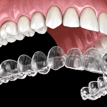 Invisalign aligner in Westfield