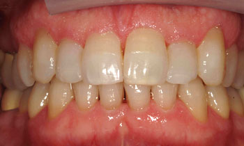 Westfield Invisalign