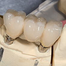 Model of smile with fixed bridge restoration