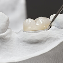Model of dental crown treated tooth