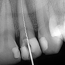 X-ray of root canal treated tooth