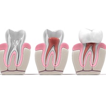 Series of models showing root canal procedure