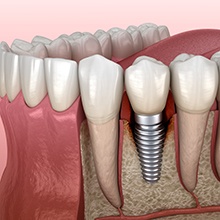 Illustration of failed dental implant in Westfield, NJ