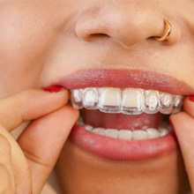 Placing clear aligners on upper teeth