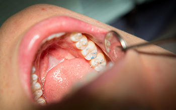 Teeth examined following filling placement