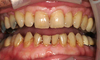 Severely yellowed and decayed teeth