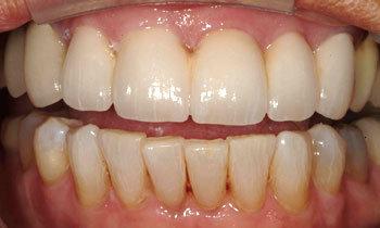 Natural looking porcelain veneer transformed smile