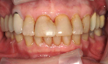 Yellowed front teeth with some wear