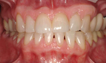 Porcelain veneer repaired chipped front tooth