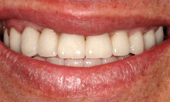 Westfield porcelain veneers