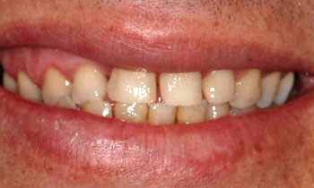 Front teeth with gaps and discoloration
