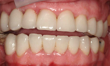 Porcelain veneer repaired smile