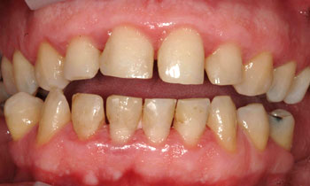 Gapped decayed and discolored teeth