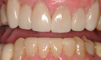 Flawed bottom teeth concealed with porcelain veneers