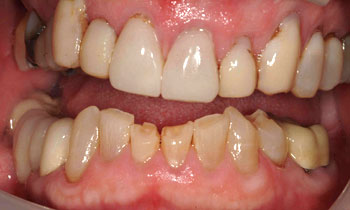 Yellow damaged and poorly shaped bottom teeth