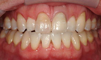 Front tooth appearance improved with porcelain veneer