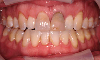 Dark front tooth