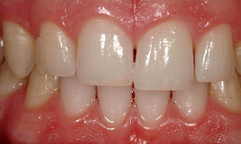 Gap between front two teeth