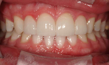 Porcelain veneer closes gap between front teeth