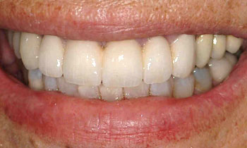 Fully transformed smile after porcelain veneers