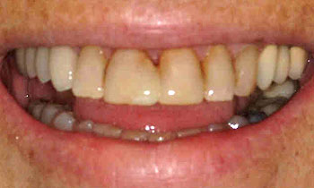 Front four teeth with severe discoloration