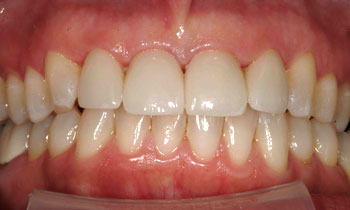Discolored and misshapen teeth concealed with porcelain veneers