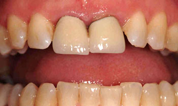 Misshapen teeth with dark line at gums