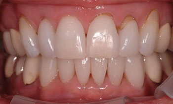 Bottom teeth concealed with porcelain veneers