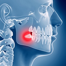 Impacted wisdom tooth in need of wisdom tooth extraction in Westfield, NJ