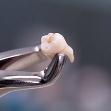 Holding tooth in forceps after wisdom tooth extraction in Westfield, NJ
