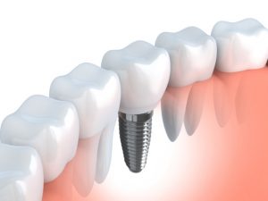 implant dentist in Westfield