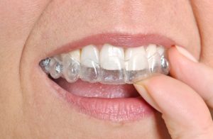 dentist in westfield on invisalign