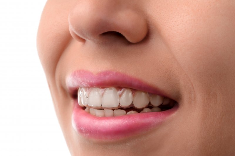 a woman wearing Invisalign braces