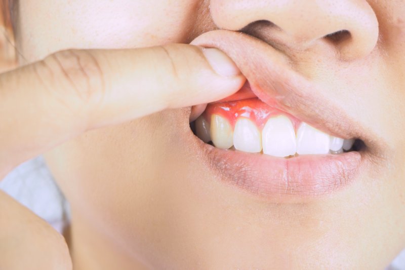 an up-close view of a person exposing their upper gums that appear red and swollen