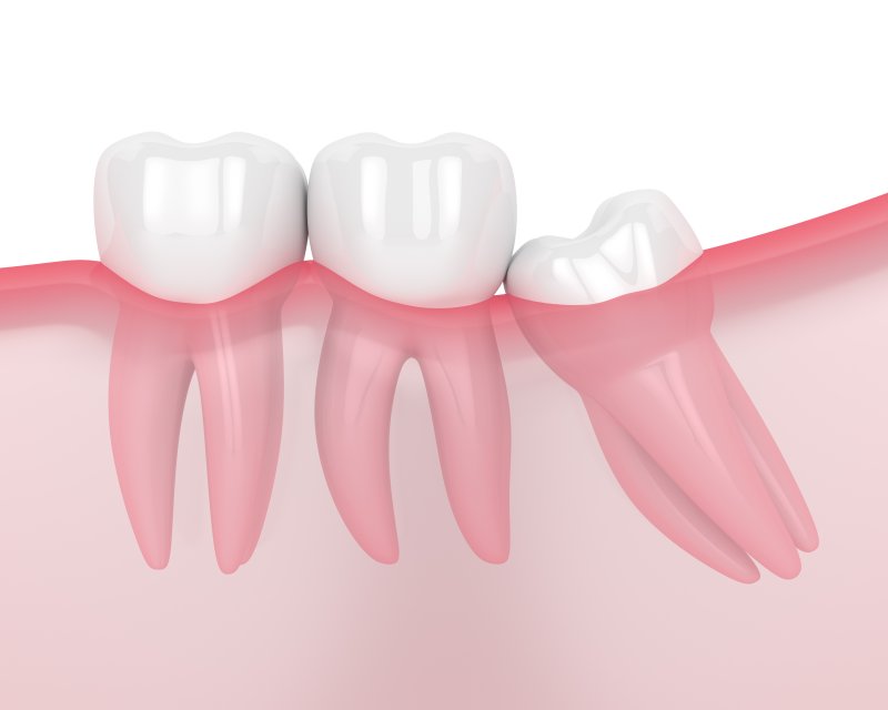 Wisdom tooth crowding natural teeth