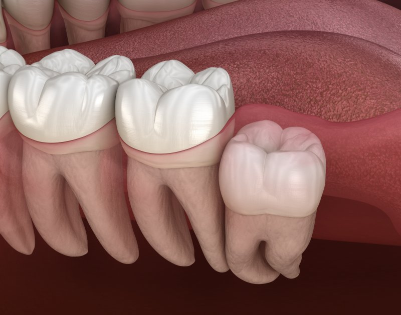 3D render of an impacted wisdom tooth