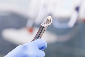 Forceps holding tooth extracted due to gum disease