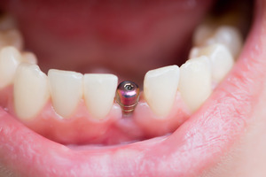 A single dental implant in the lower jaw