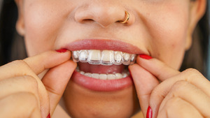 Woman placing Spark clear aligners on her upper teeth